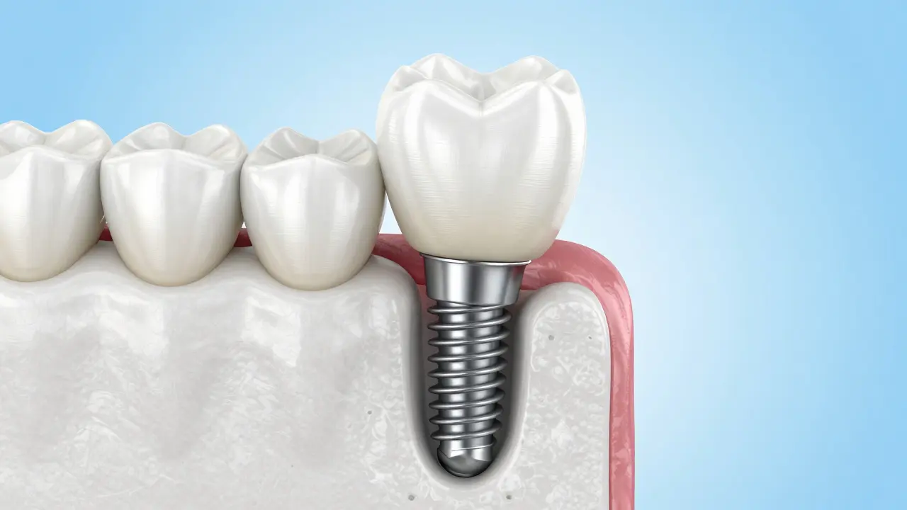 3D ilustrace zubního implantátu integrovaného do čelistní kosti